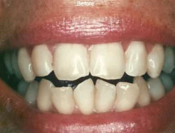 Before: a smile with small, spaced upper front teeth