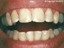 After: the same smile with the front teeth reshaped and the gaps closed