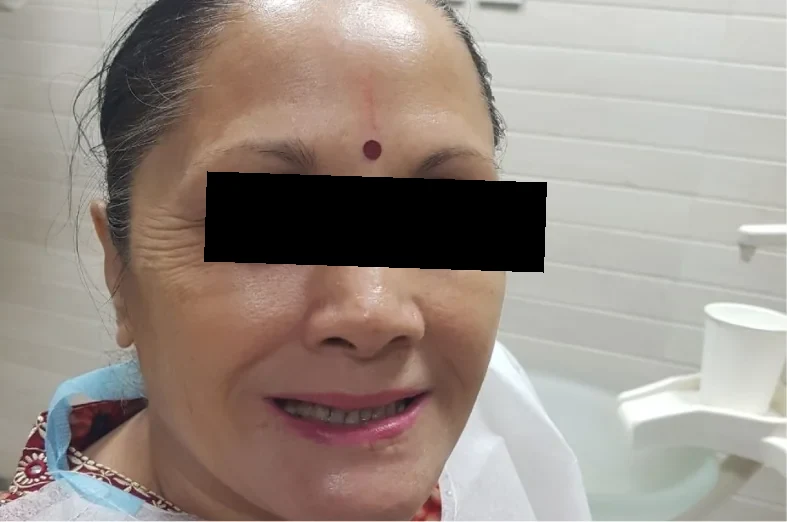 Before: a woman smiling in the dental chair, her front teeth worn and discoloured