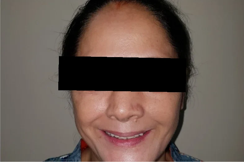 After: the same woman smiling with new front teeth