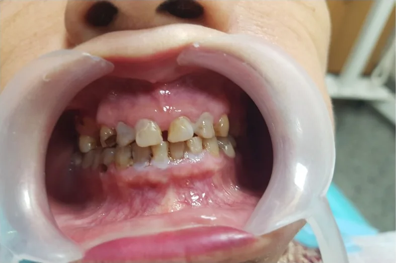 Before: her upper front teeth worn, gapped and stained, lips held back with a cheek retractor