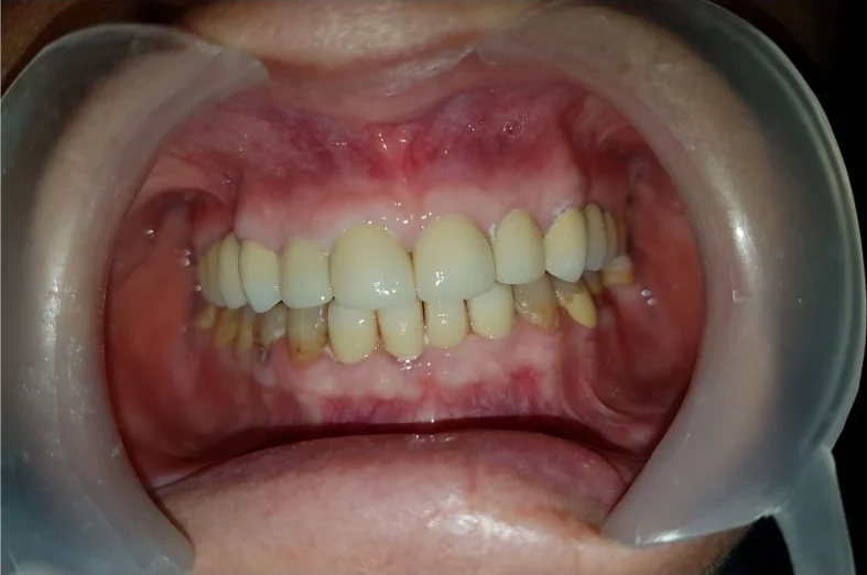 After: the same teeth restored with new crowns across the front