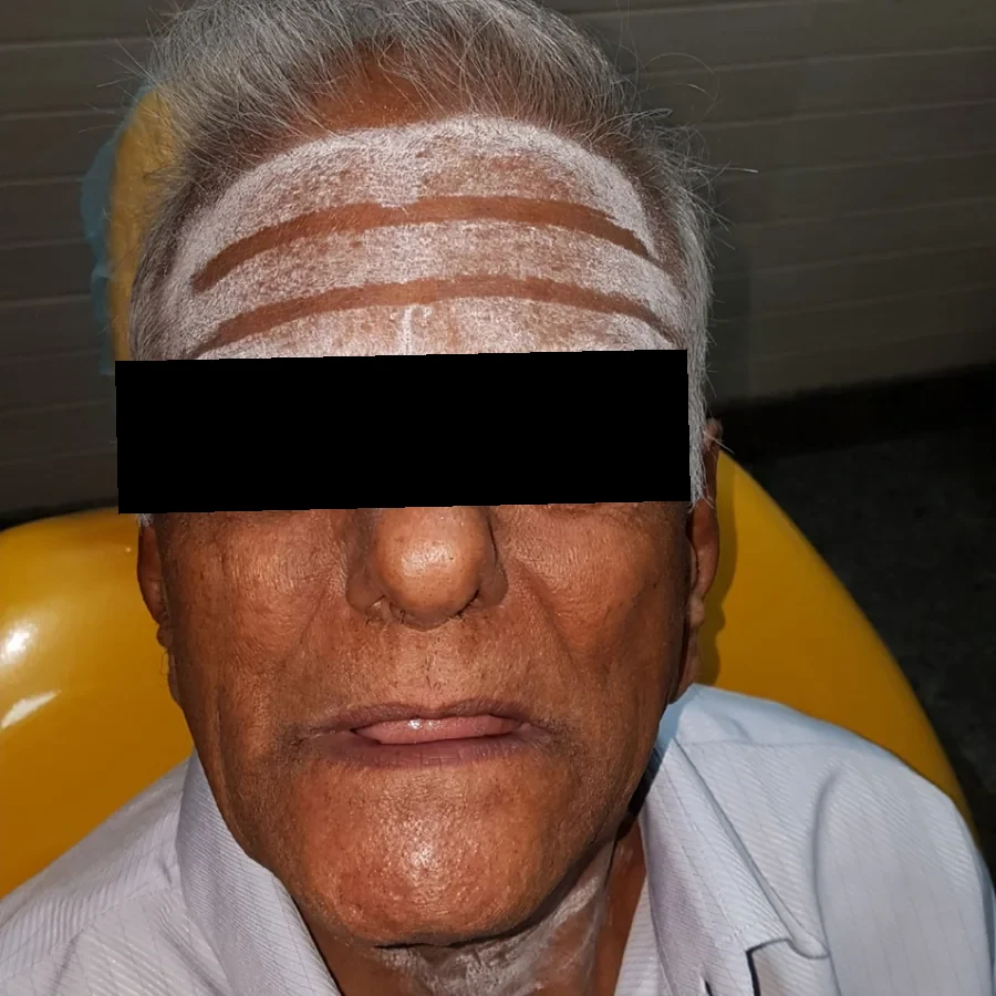Before: an elderly man in the dental chair without his teeth, lips drawn in