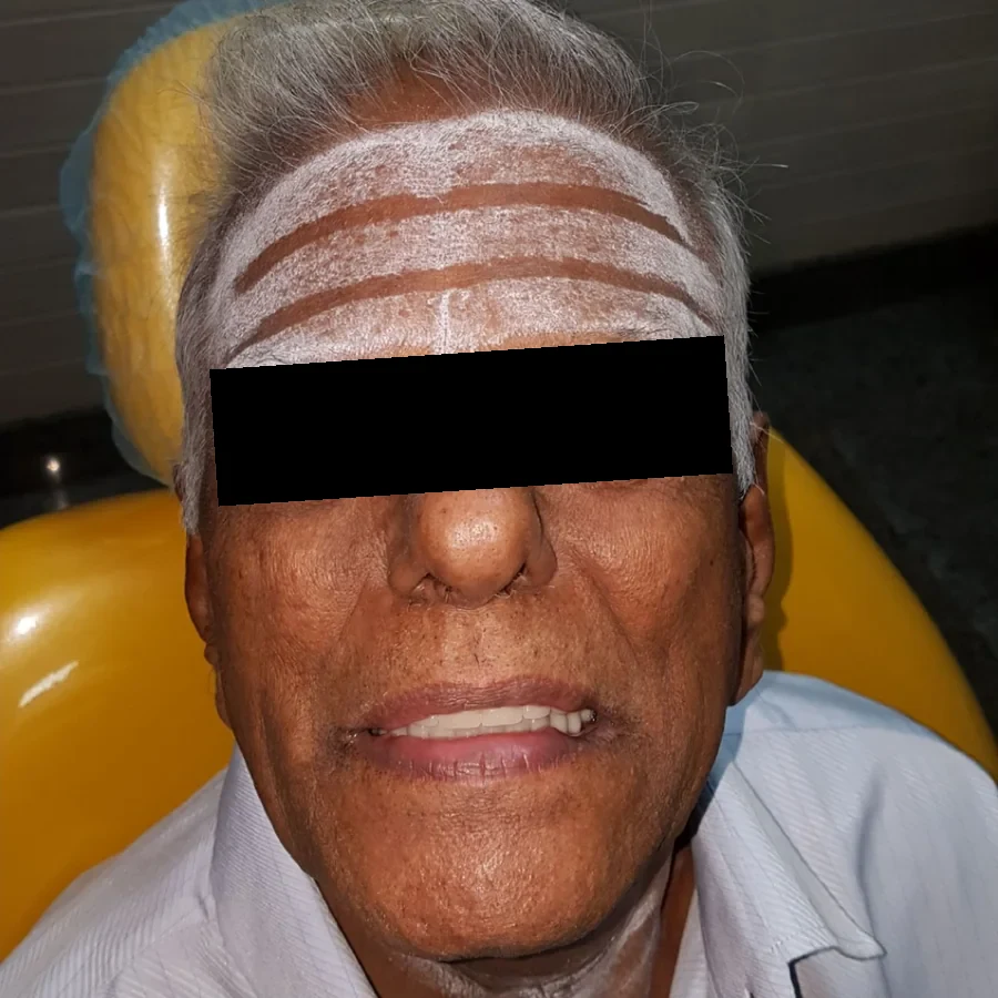 After: the same man with his new full dentures in