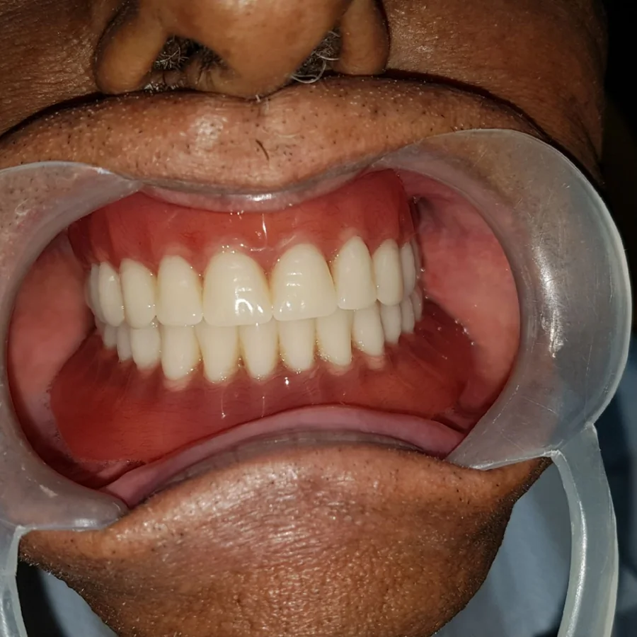 His new upper and lower dentures seen from the front, cheeks held back with a retractor