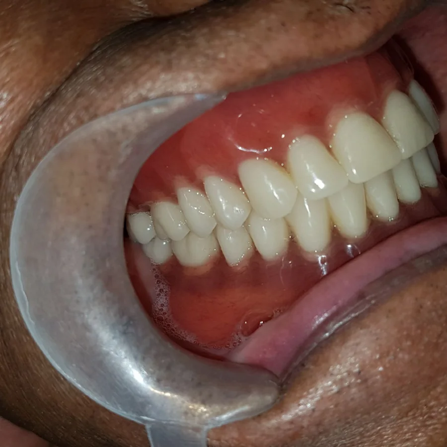 The same dentures seen from the side