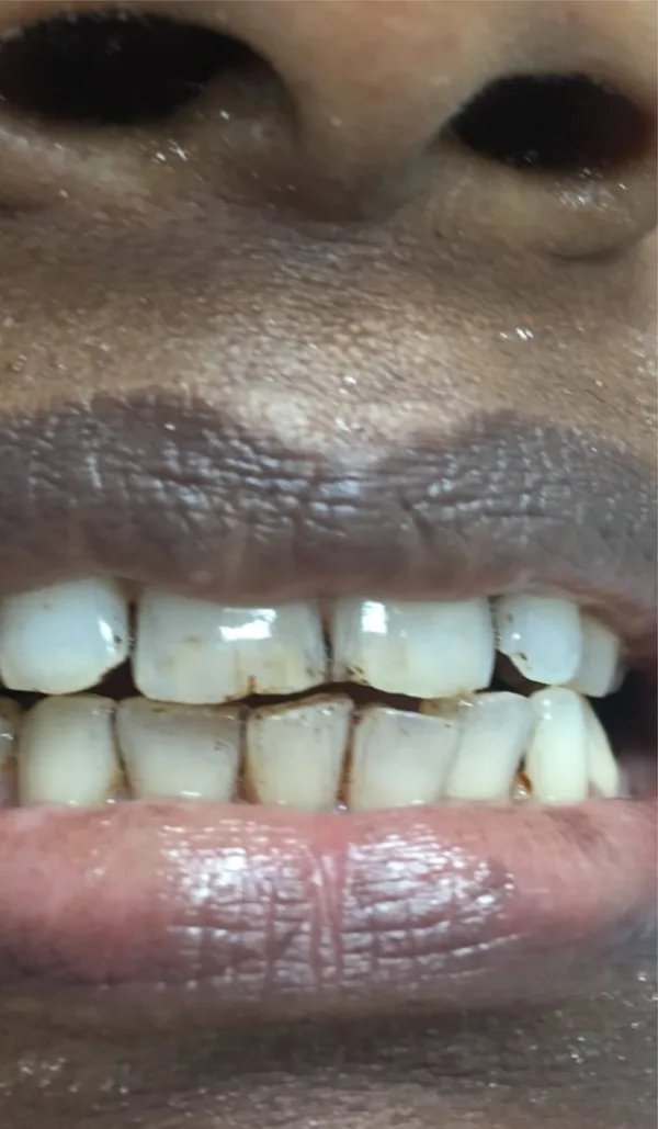After: the same teeth cleaned, with the stain removed