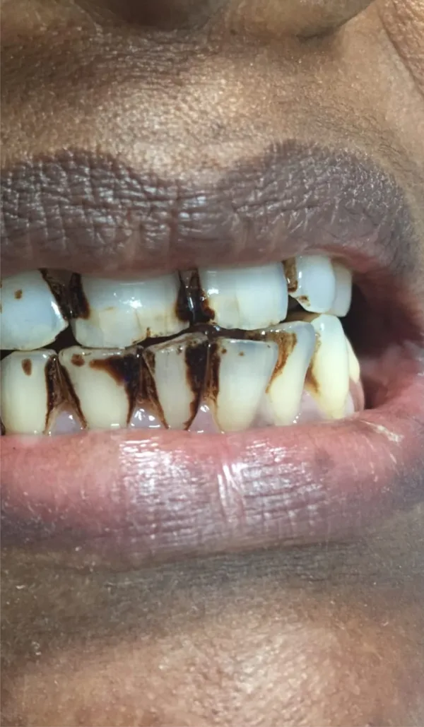 Before: close-up of teeth with heavy brown stain between them