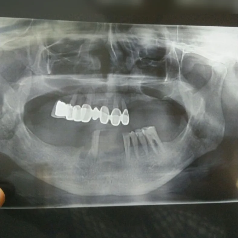 Before: a panoramic X-ray showing most of the teeth missing
