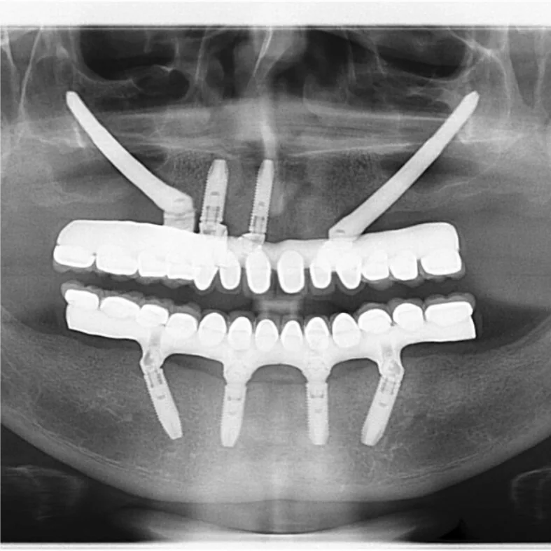 After: a panoramic X-ray with implants carrying full upper and lower bridges