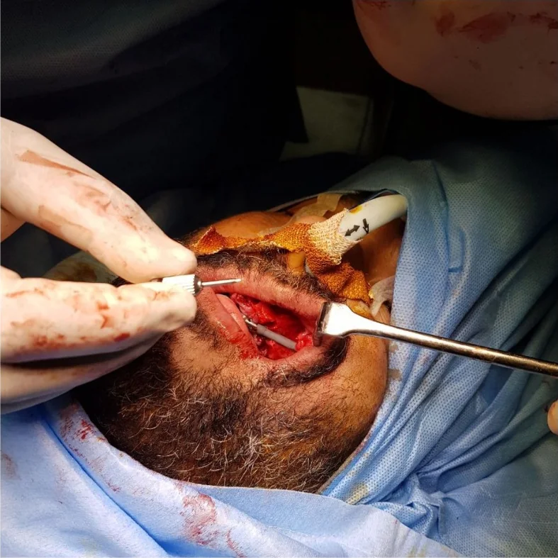 Placing an implant during surgery
