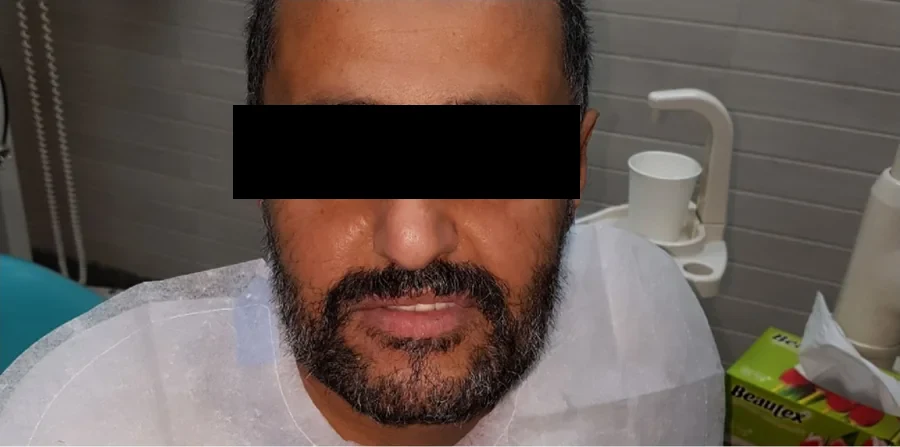 Before: a man in the dental chair before his implant treatment