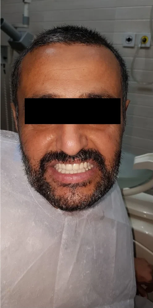 After: the same man smiling with his new teeth