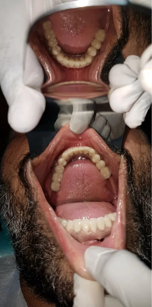 His new upper and lower teeth seen from above and below