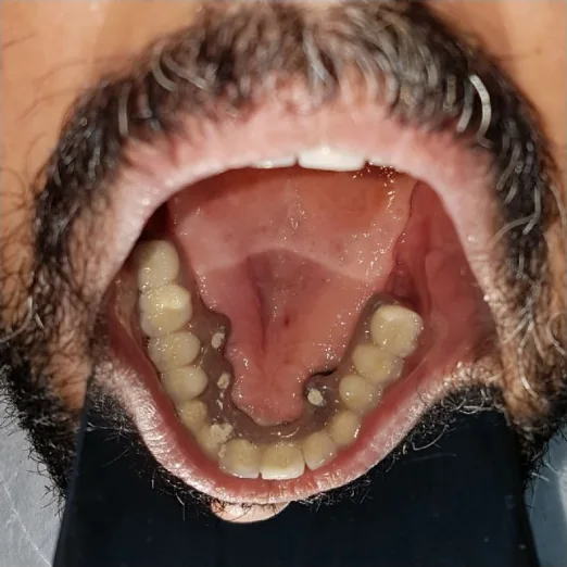 His lower teeth before treatment, seen from above