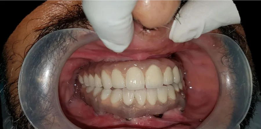 His new fixed teeth seen from the front, lips held back