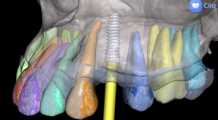 A 3D plan of an implant placed between the teeth of the upper jaw
