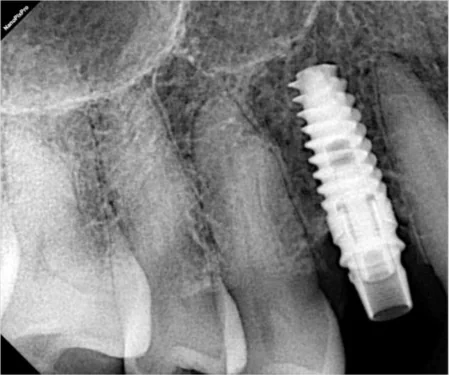 An X-ray of a single implant in place in the upper jaw