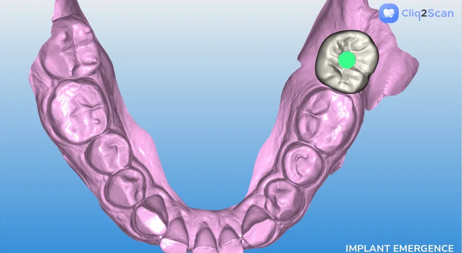A 3D scan of the lower jaw showing where an implant crown will sit