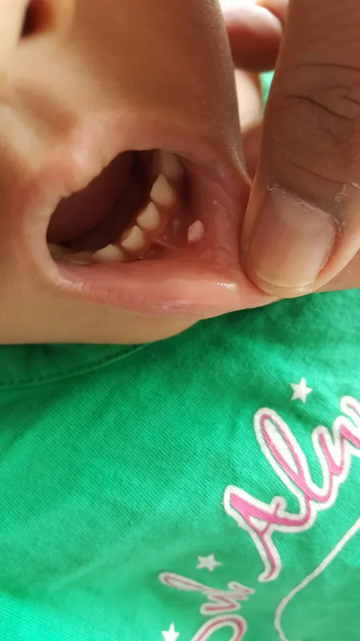 A small pale growth on the inside of a child's lower lip, the lip held down with a thumb