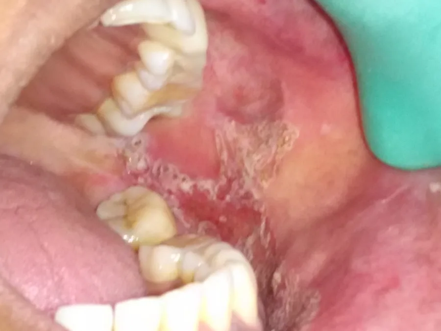 A white, lace-like patch on the inside of the cheek, beside the back teeth