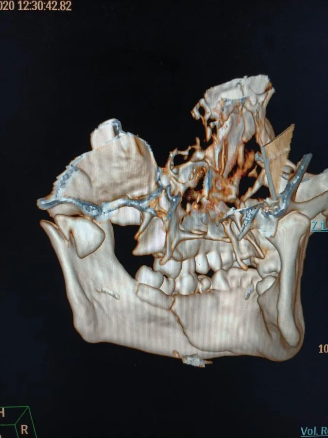 A 3D CT reconstruction of the jaws and face, showing the fixation plates used to repair the facial bones