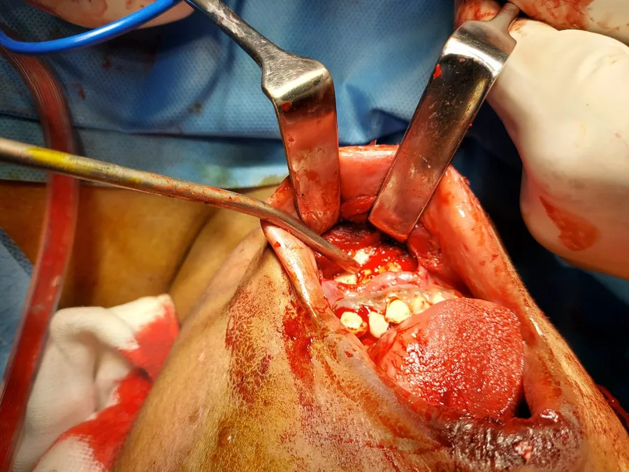 Surgery inside the mouth under general anaesthetic, the lips held back with retractors