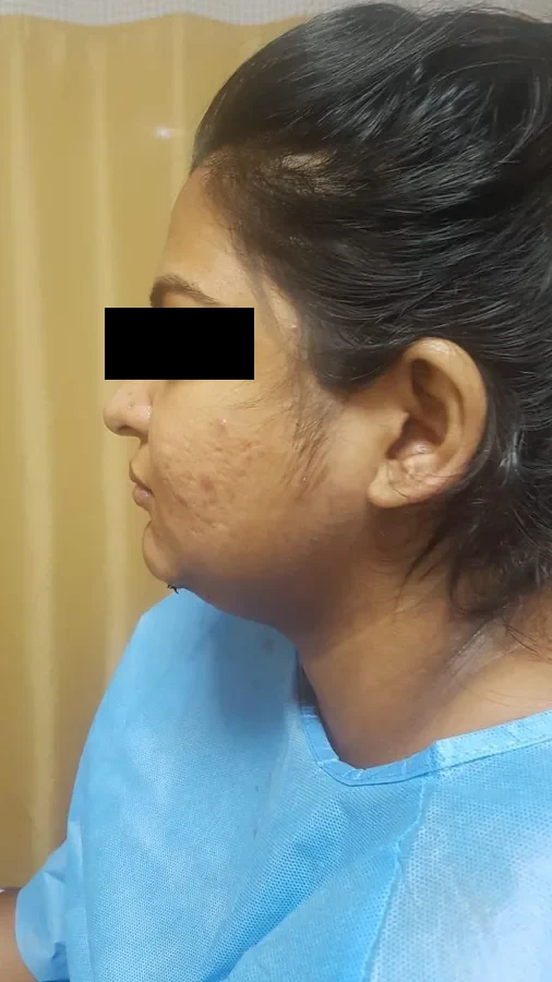 A patient seen in profile after surgery, showing the line of her jaw and neck