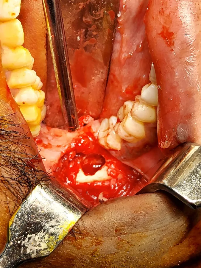 An opening made in the lower jaw during surgery, beside the back teeth