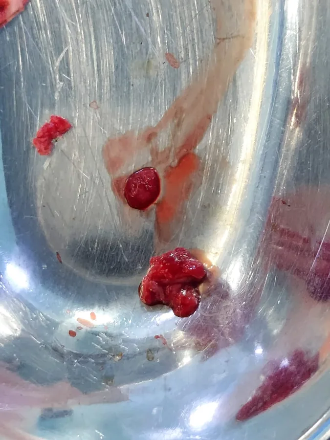 Tissue removed during surgery, in a steel dish