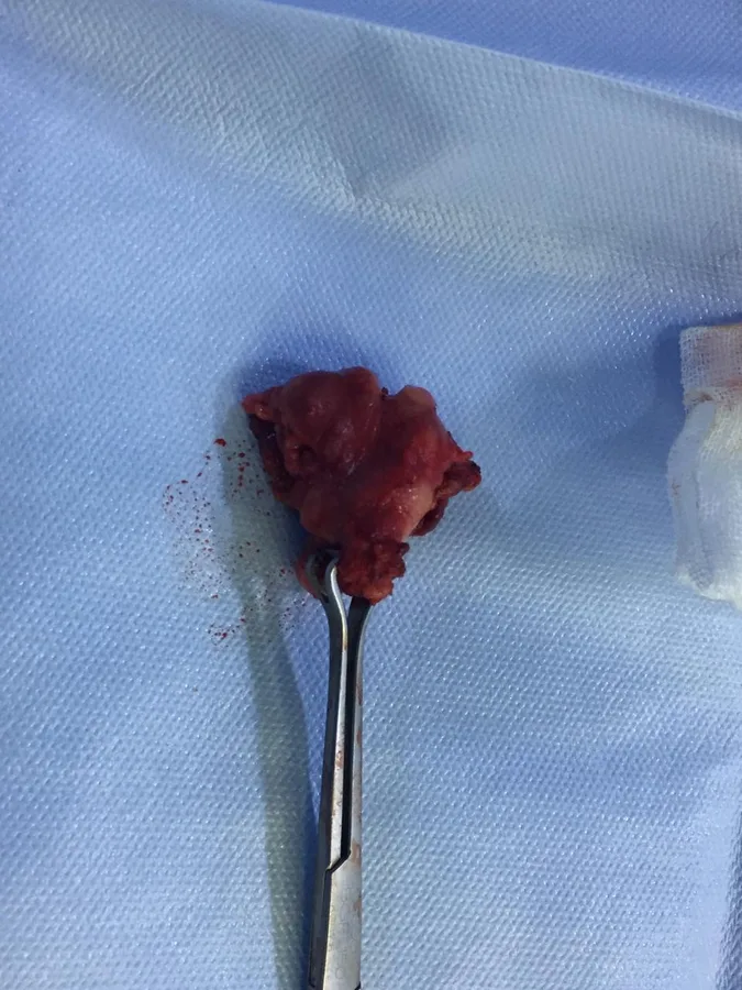 A specimen removed during surgery, held in forceps