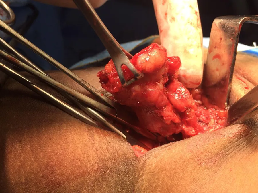 Surgery through the skin of the neck, with the tissue being lifted out
