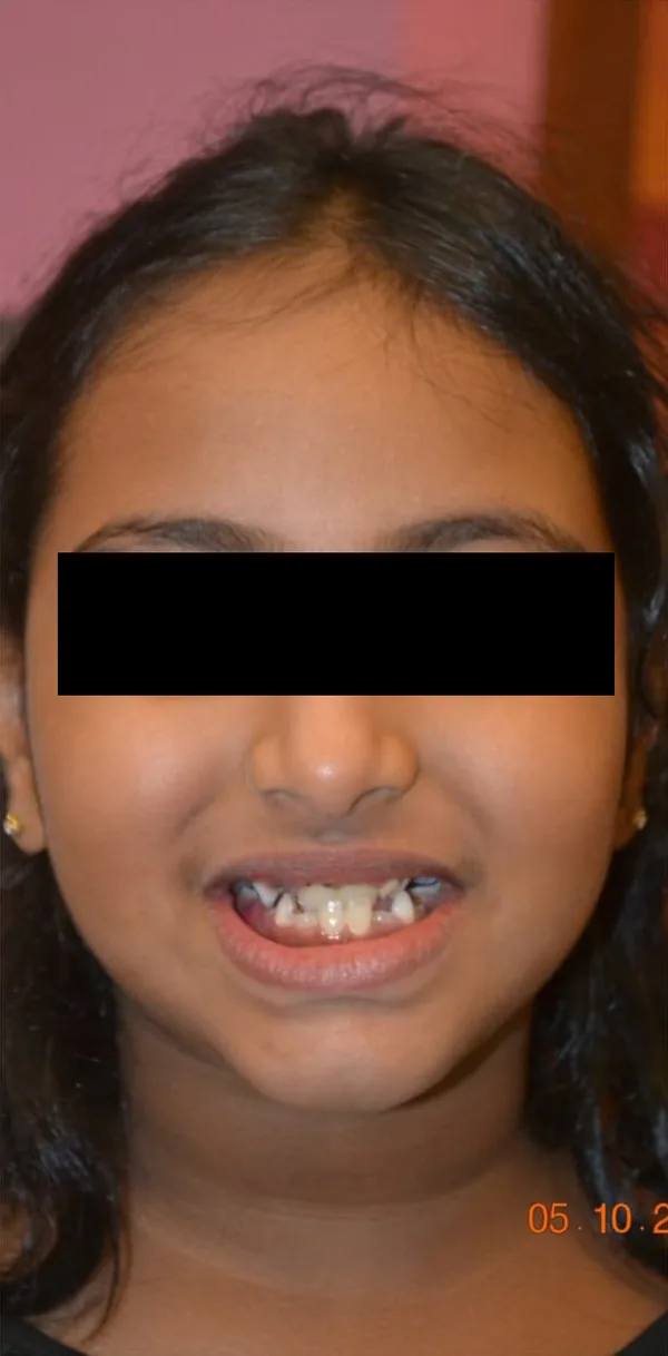 A girl smiling, her eyes covered, with crowded and uneven upper front teeth