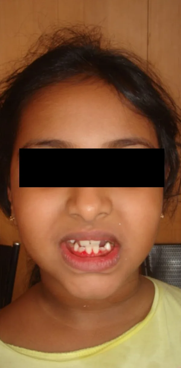 The same girl at a later visit, her eyes covered, with the front teeth spaced apart