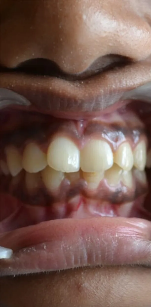 Before: upper front teeth crowded and overlapping