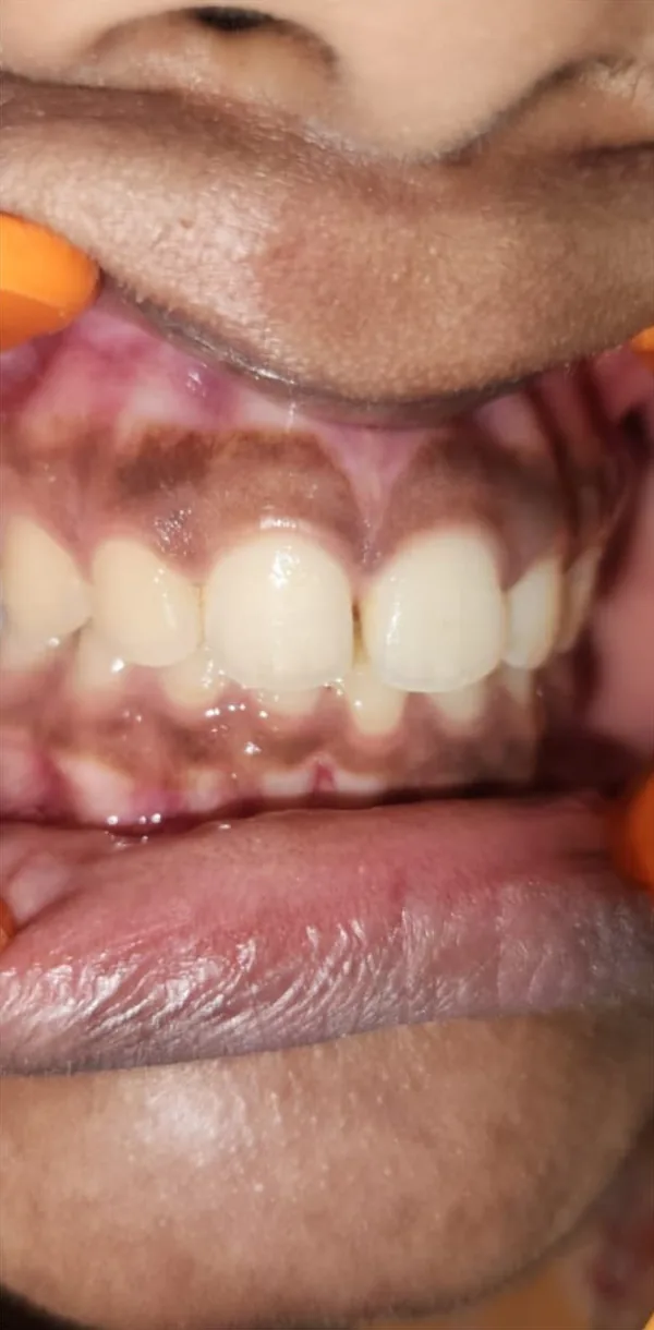After: the same teeth in line