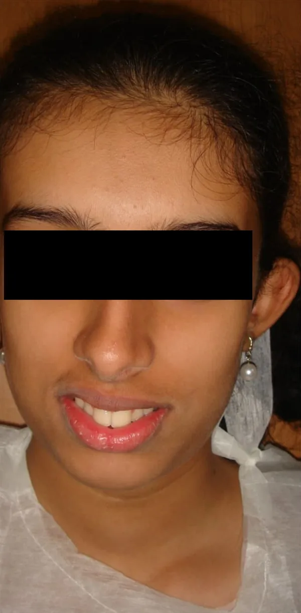 Before: a young woman smiling, her eyes covered, with tilted upper front teeth