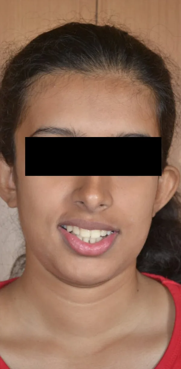 After: the same young woman smiling with an even row of teeth, her eyes covered