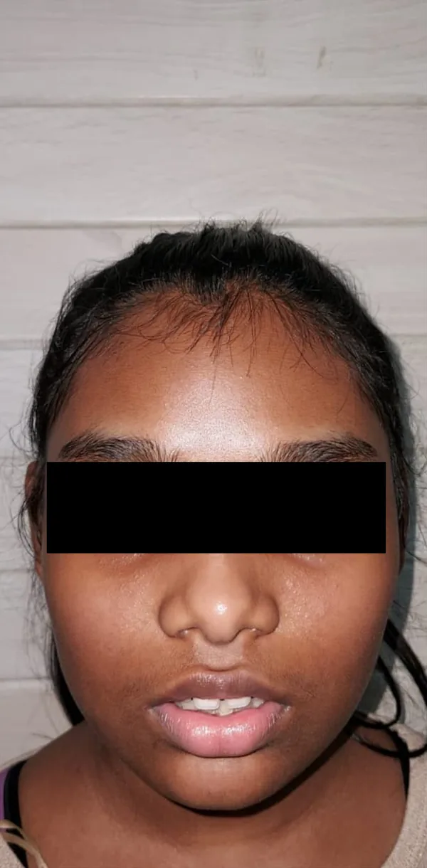 Before: a girl with her lips slightly apart, her eyes covered