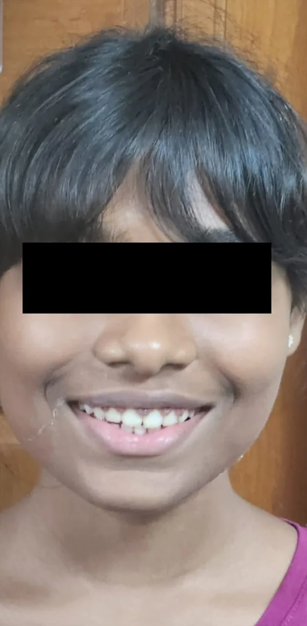 After: the same girl smiling widely, her eyes covered
