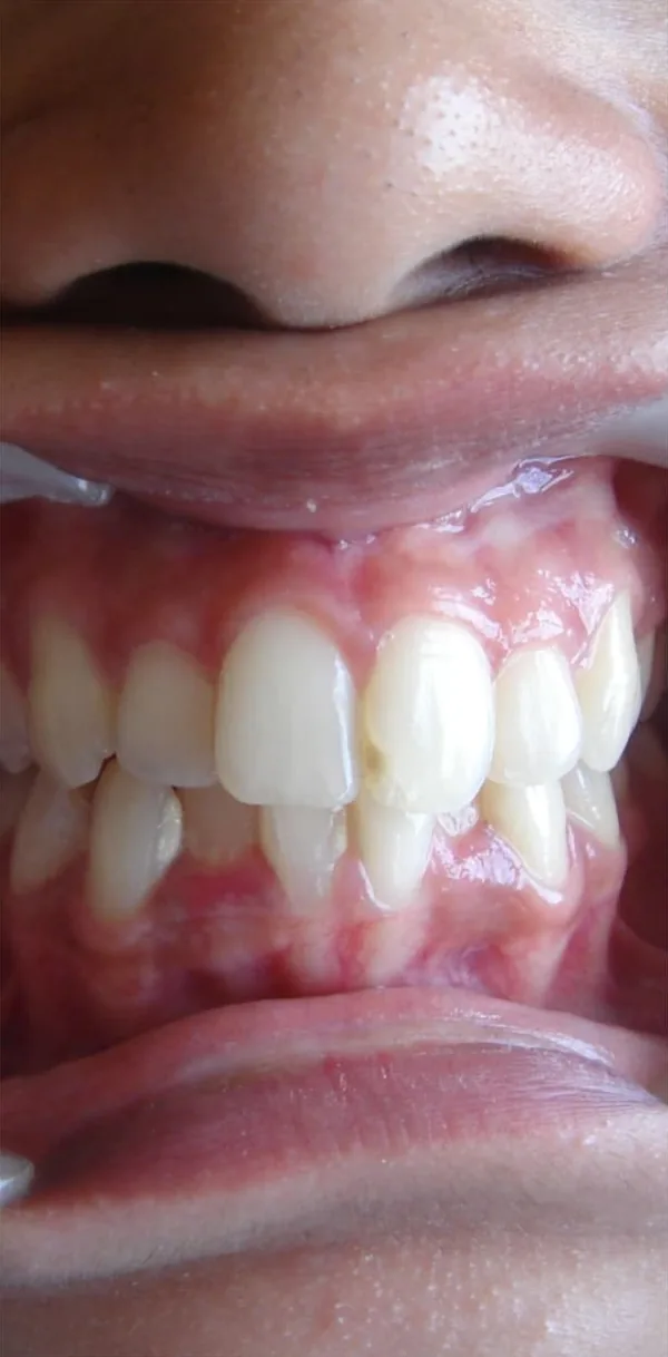 Before: crowded front teeth with one canine sitting high