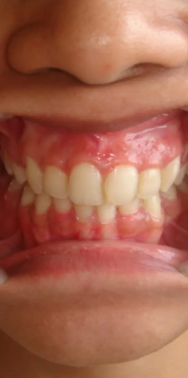 After: the same teeth level and in line