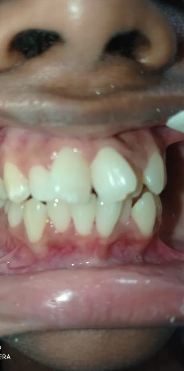 Before: crowded upper and lower front teeth