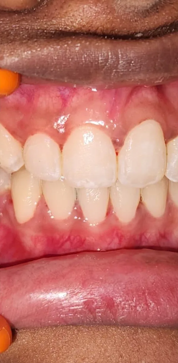 After: the same teeth in an even row