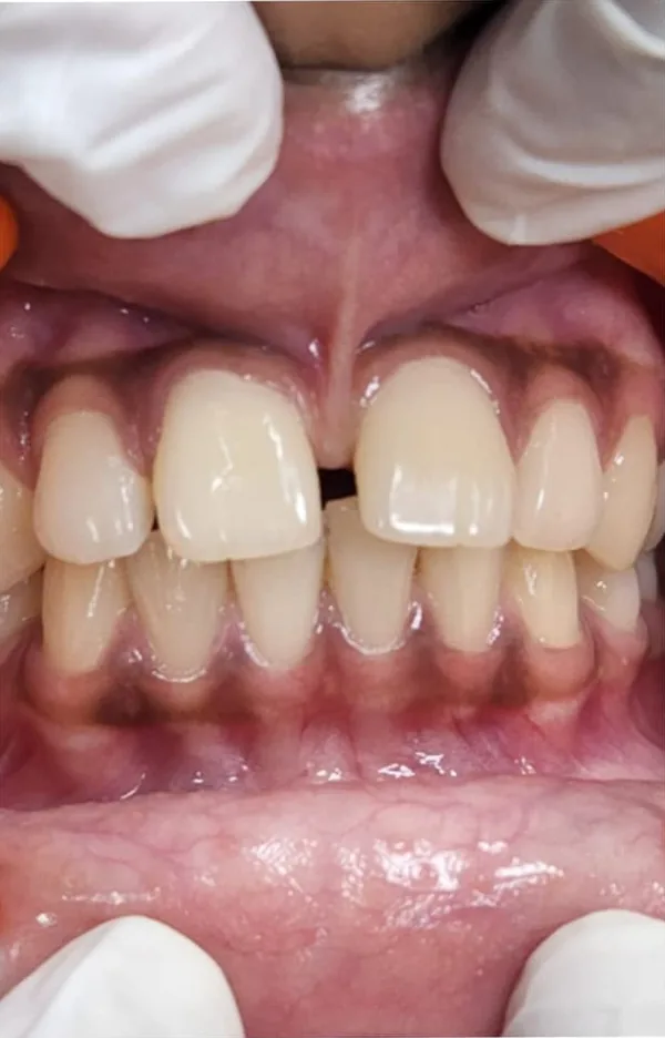 Before: a gap between the two upper front teeth