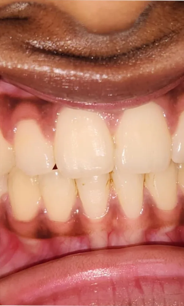 After: the same teeth with the gap closed