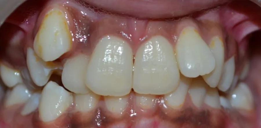 Before: severely crowded teeth, with the canines sitting high on both sides