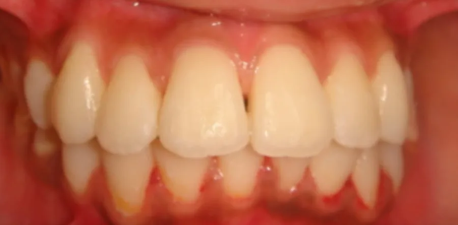 After: the same teeth aligned in an even arch