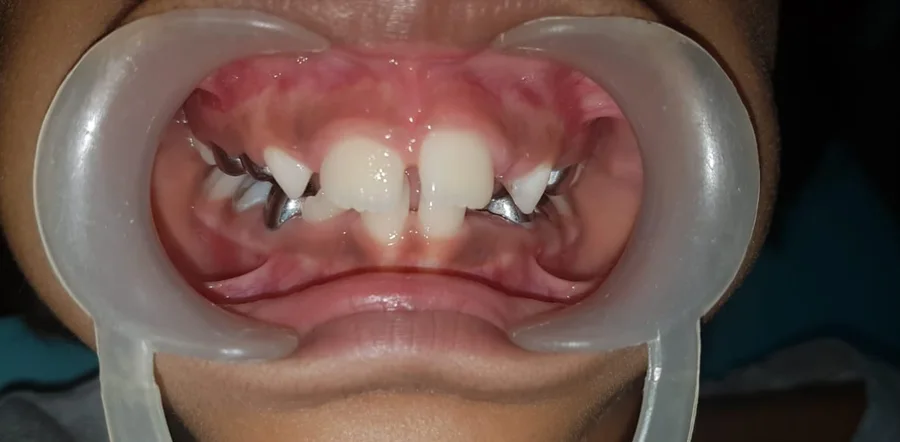 A child's upper front teeth before treatment, lips held back with a cheek retractor