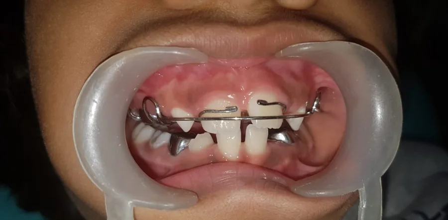 The same child with a removable appliance fitted across the upper teeth